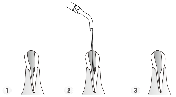 Сфера применения наконечника для скалера